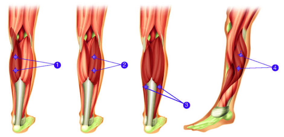  En illustartion av injektionsställen i fotledsmusklerna